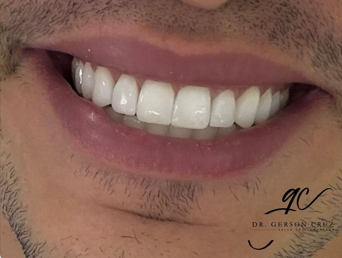 Diseño de Sonrisa - Antes