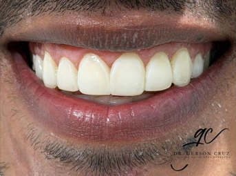 Diseño de Sonrisa - Carillas de porcelana