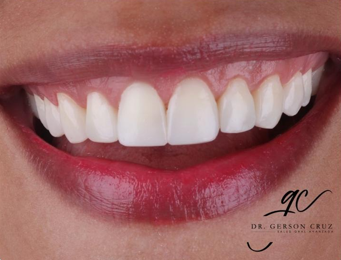 Diseño de Sonrisa - Resultado final