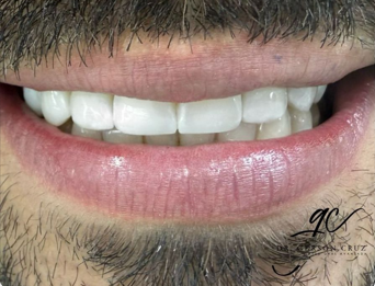 Diseño de Sonrisa - Antes