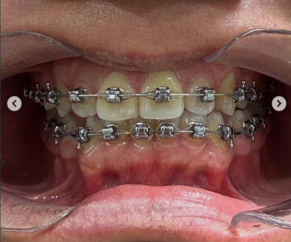 Ortodoncia - Brackets metálicos