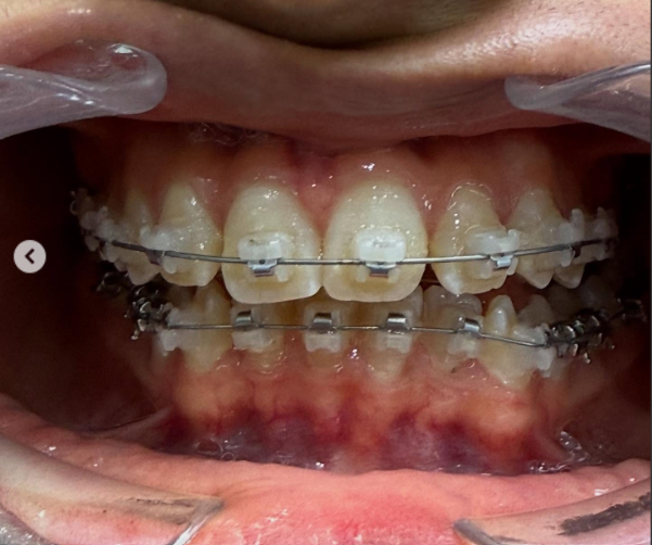 Ortodoncia - Brackets estéticos