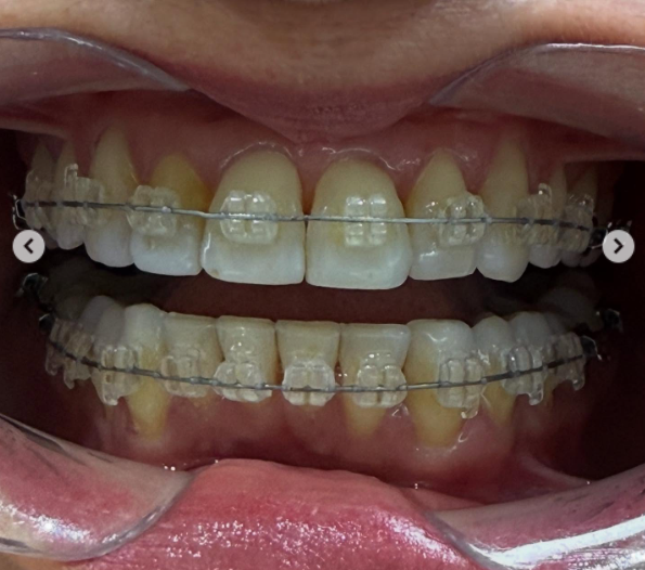 Ortodoncia - Alineadores invisibles