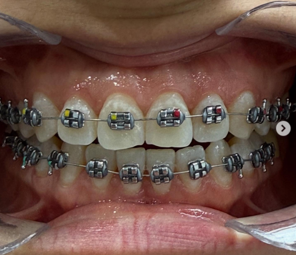 Ortodoncia - Alineadores invisibles